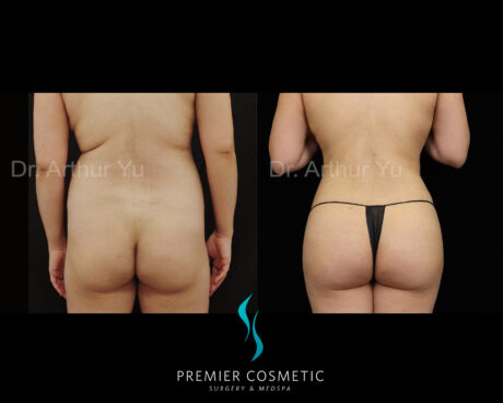 Back Liposuction case #2820