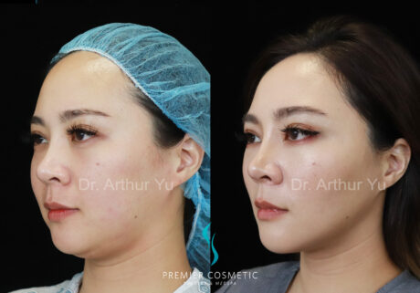 Face Liposuction case #18243