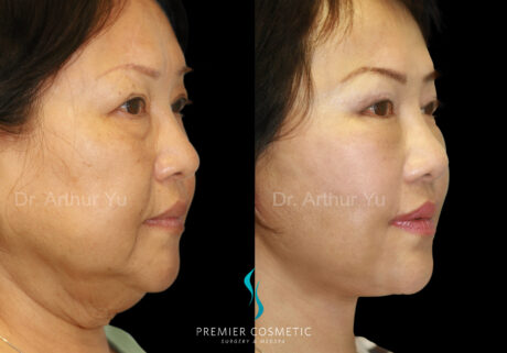Facelift case #18247