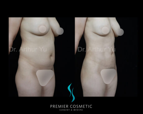 Liposculpture case #18191