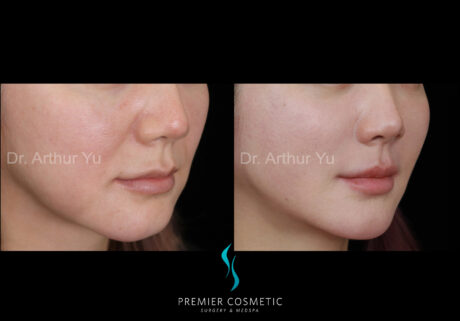 SMAS PDO Thread Lift case #18228