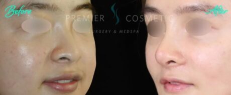 Rhinoplasty case #18221