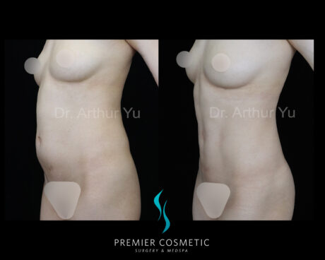 Liposculpture case #18192