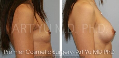 Breast Augmentation With Lift case #1955