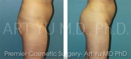 Butt Fat Grafting case #17507