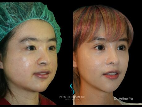 Buccal Fat Removal case #18237