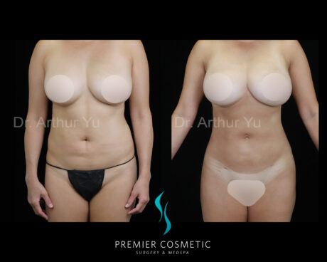 Body Liposuction case #2995