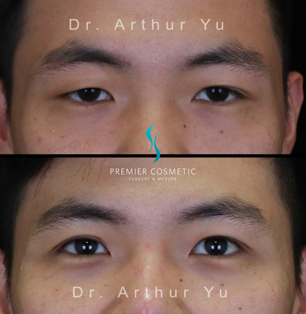 Upper Eyelid Surgery case #3134