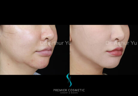Buccal Fat Removal case #2854