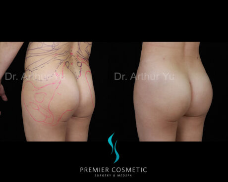 Butt Fat Grafting case #17503