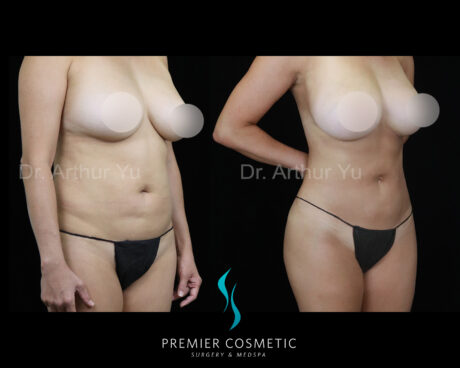 Liposculpture case #18190