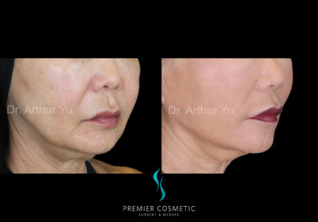 SMAS PDO Thread Lift case #18227