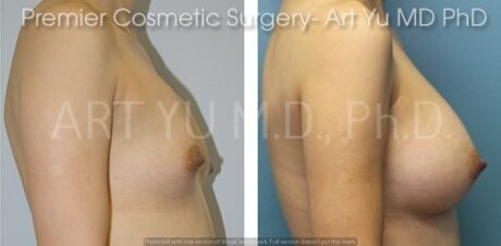 Breast Augmentation With Lift case #1957