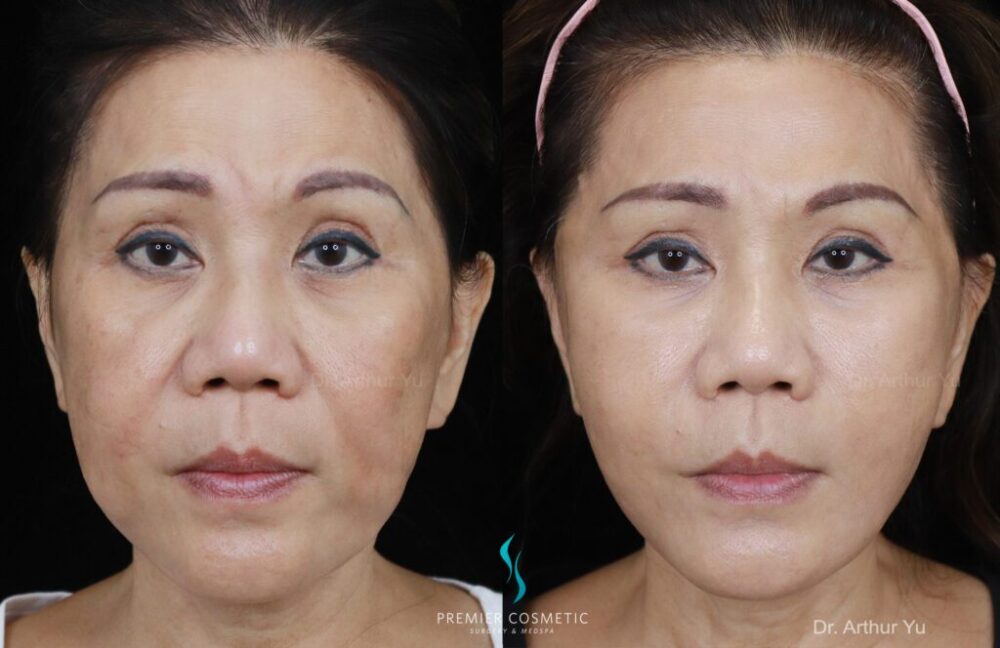 Buccal Fat Removal case #1999