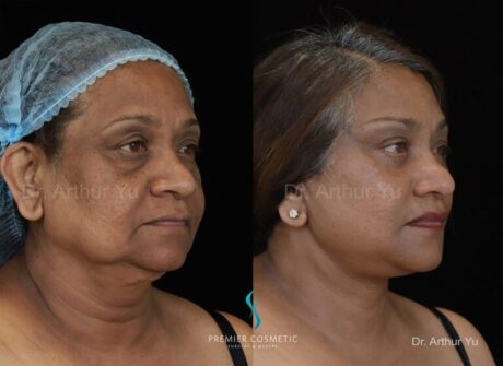 Facelift case #2064