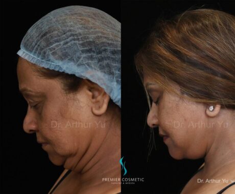 Facelift case #18252