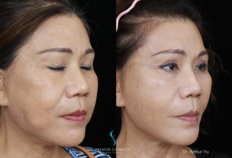 Buccal Fat Removal case #18238