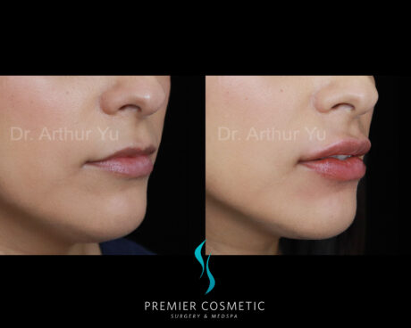 Lip Filler case #3016