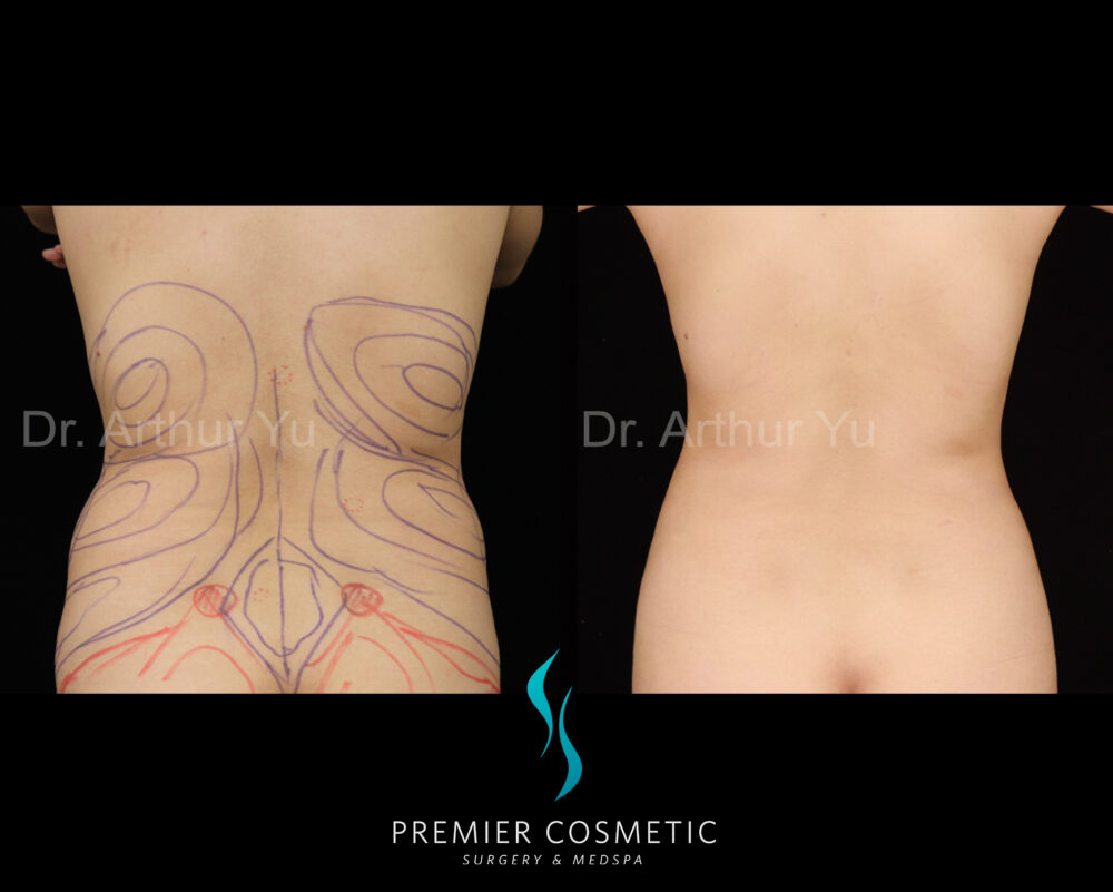 Back Liposuction case #2824