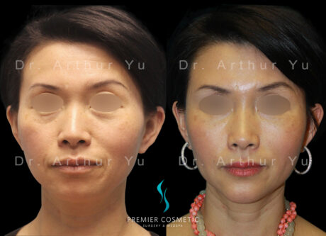 Full Face Fat Grafting case #2887