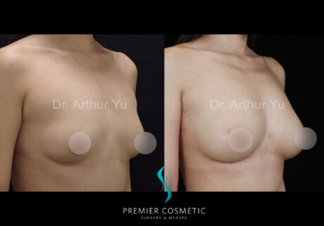 Breast Fat Grafting case #18258