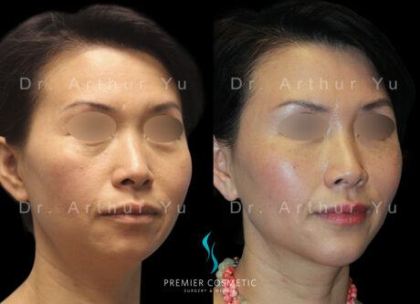 Full Face Fat Grafting case #17529