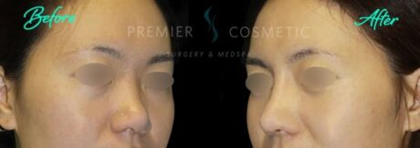 Rhinoplasty case #18220