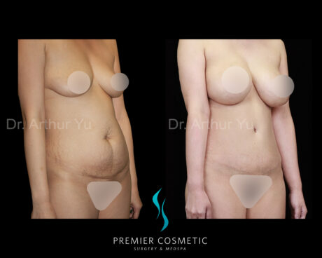 Tummy Tuck case #18204