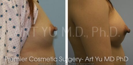 Breast Augmentation With Lift case #1959