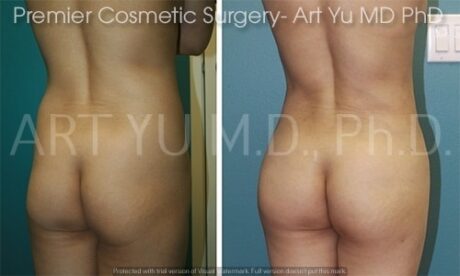 Butt Fat Grafting case #17506