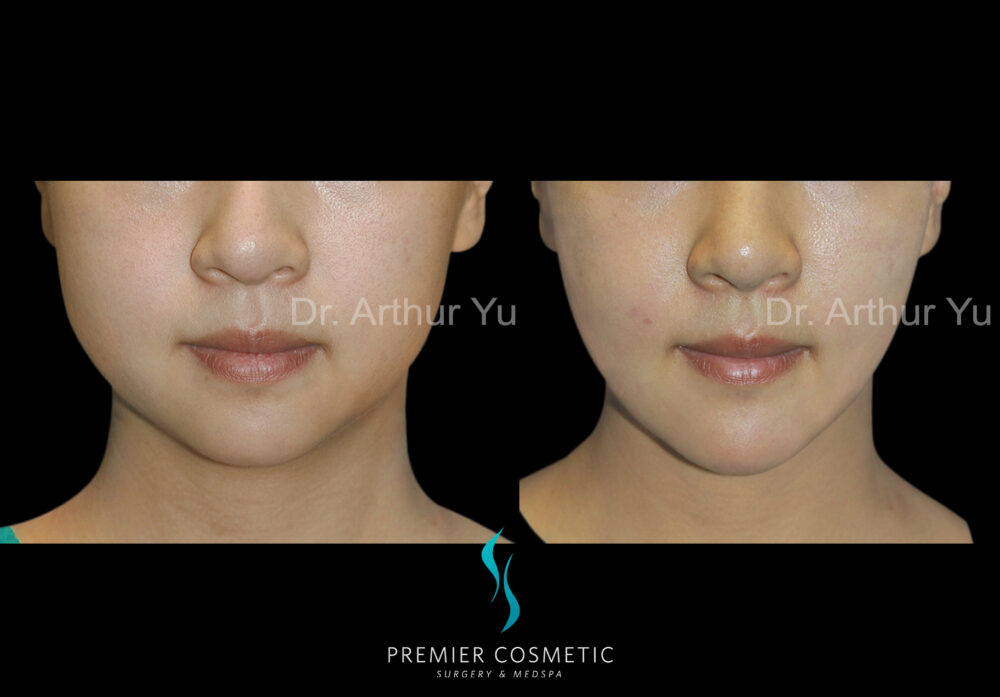 Face Liposuction case #2921