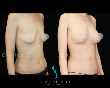 Belly Button Lift case #17498