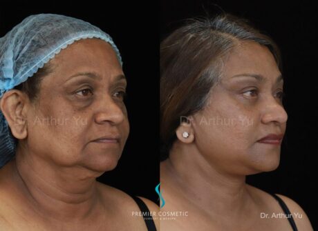 Buccal Fat Removal case #2005