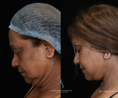 Buccal Fat Removal case #18235