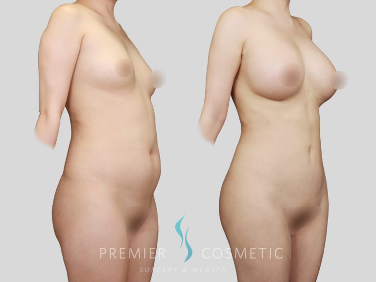 Liposuction case #2153