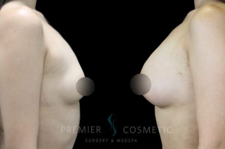 Breast Fat Grafting case #18257