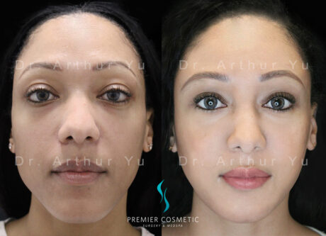 Full Face Fat Grafting case #2892