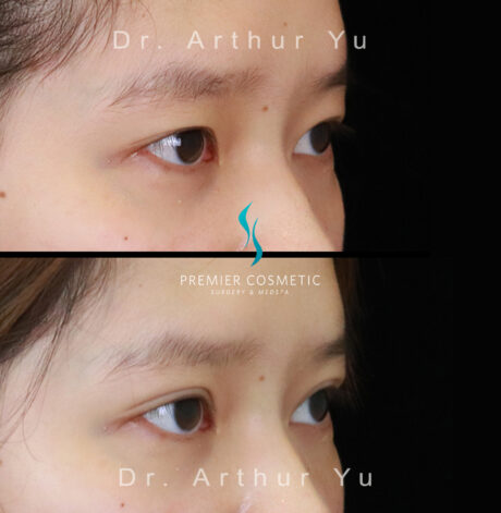 Upper Eyelid Surgery case #18232