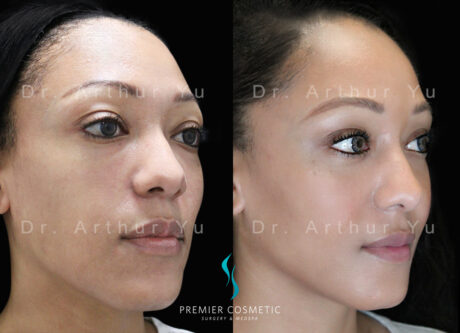 Full Face Fat Grafting case #17528