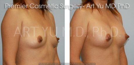Breast Augmentation With Lift case #1963