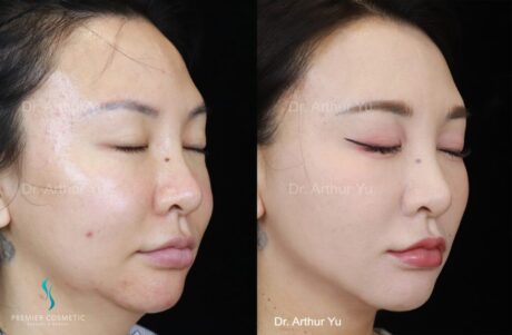 Buccal Fat Removal case #2007