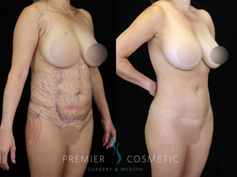 Liposuction case #2155