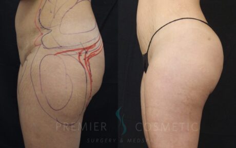 Butt Fat Grafting case #17504