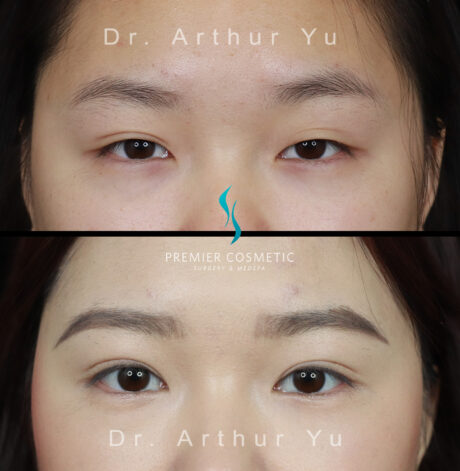 Upper Eyelid Surgery case #3144