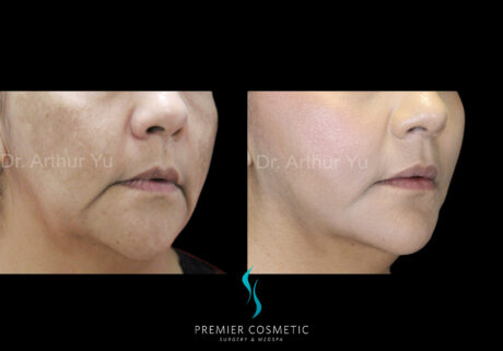 Facelift case #18246