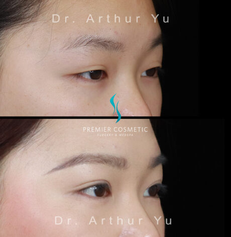 Upper Eyelid Surgery case #18231