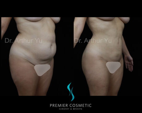 Belly Button Lift case #17497