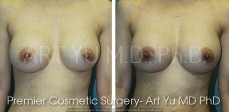 Breast Augmentation With Lift case #1964
