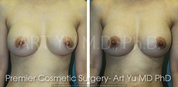 Breast Augmentation With Lift case #1964