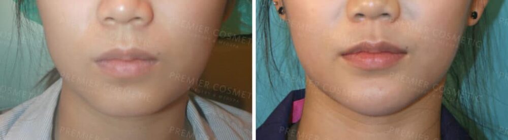 Jowl Fat Removal Smart Lipo case #2136